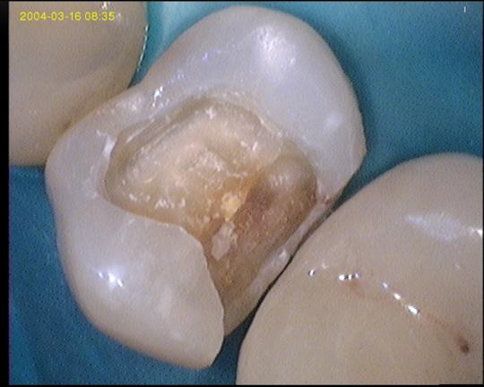 L'évolution du plombage gris (amalgame dentaire) au cours des siècles.